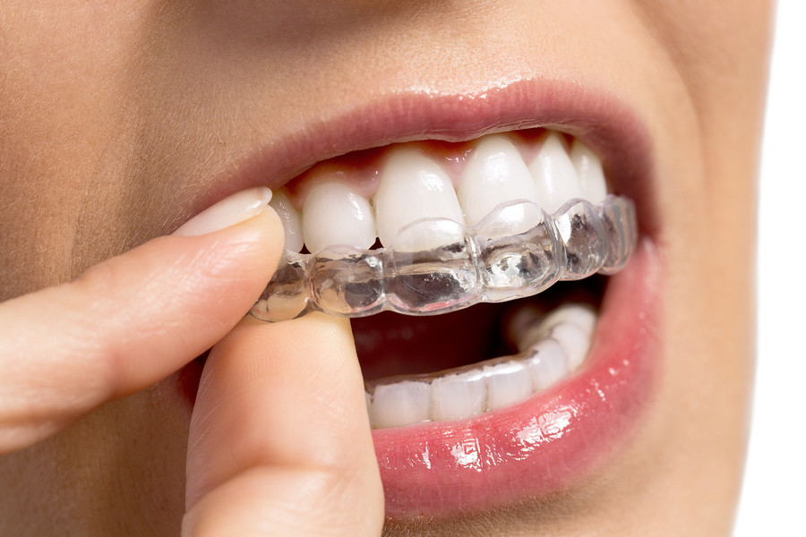 Understanding Everything About an Invisalign Treatment